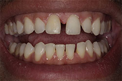 Close up of smile before cosmetic dental bonding